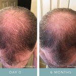Hair Loss - Before + After 