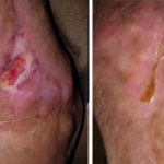 NeoGenesis Recovery for Wound Healing
