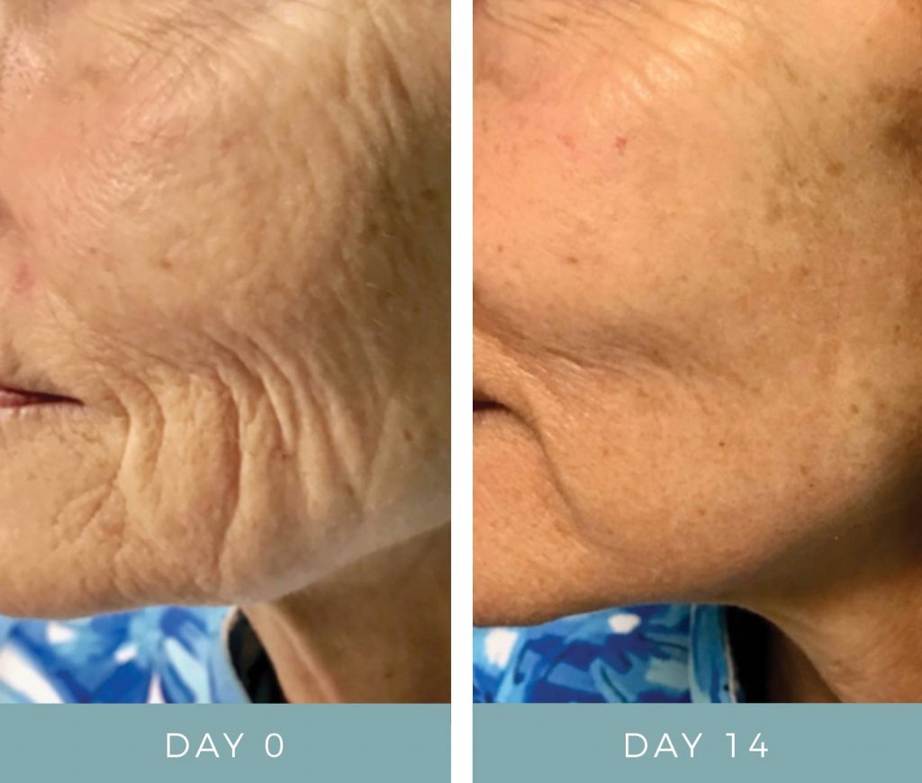 Before & After - Fibroblast