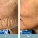 Before & After - Fibroblast