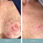 Before & After - IPL Laser Burn