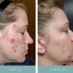 Acne - Before + After