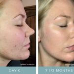 Before + After - Acne