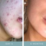 Before + After - Acne