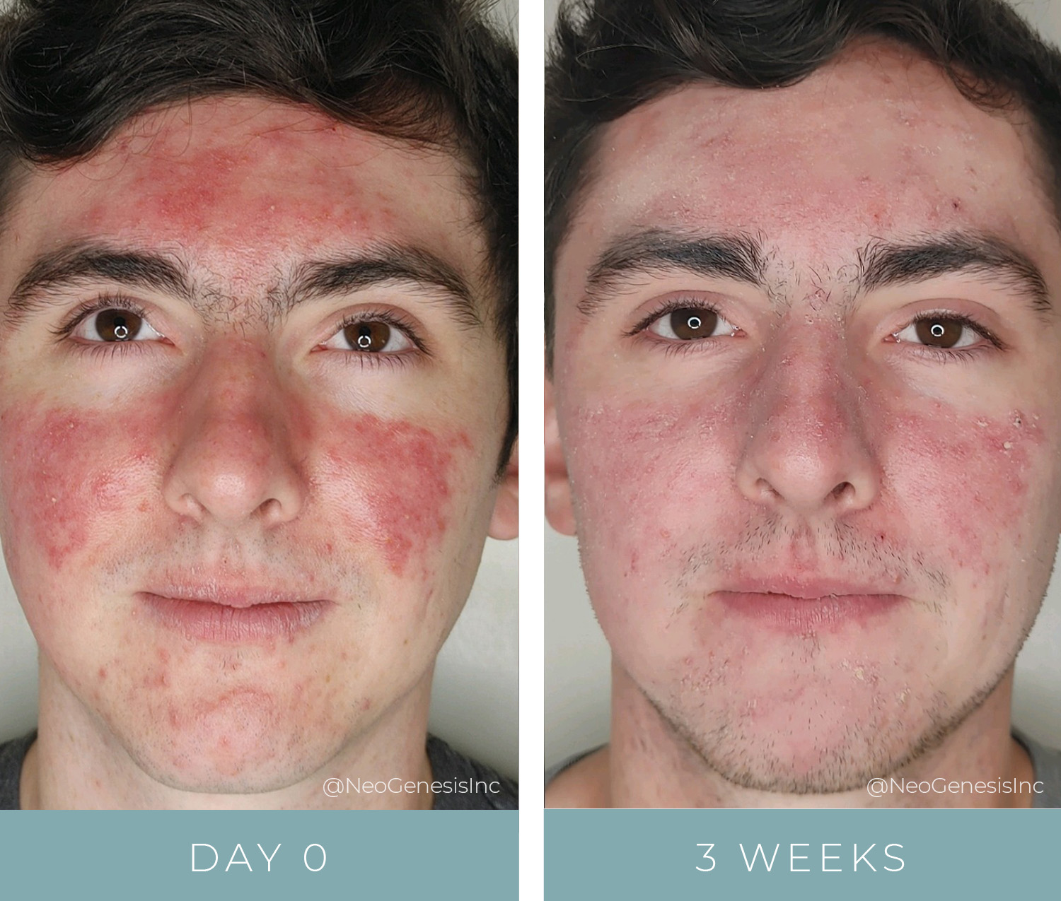 Salicylic Acid Acne Before And After