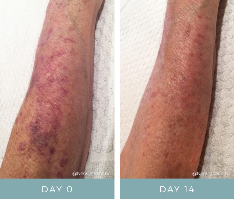 Before & After - Actinic Purpura