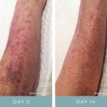 Before + After - Actinic Purpura