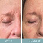 Before + After - Aging Skin