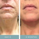 Before + After - Aging Skin