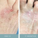 Before + After - Wound Care -Burn 