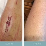 Before + After - Wound Care - Tumor
