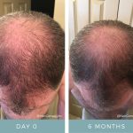 Hair Loss - Before & After - NeoGenesis Hair Thickening Serum