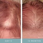 Hair Loss - Before & After - NeoGenesis Hair Thickening Serum