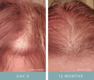 Hair Loss - Before & After - NeoGenesis Hair Thickening Serum