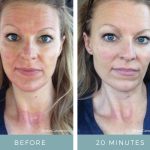 Before & After - Microneedling