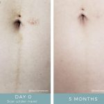 Before + After - Post Pregnancy Scarring
