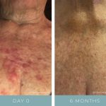 Before + After - Radiation Dermatitis