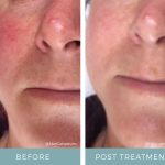 Before + After - Rosacea