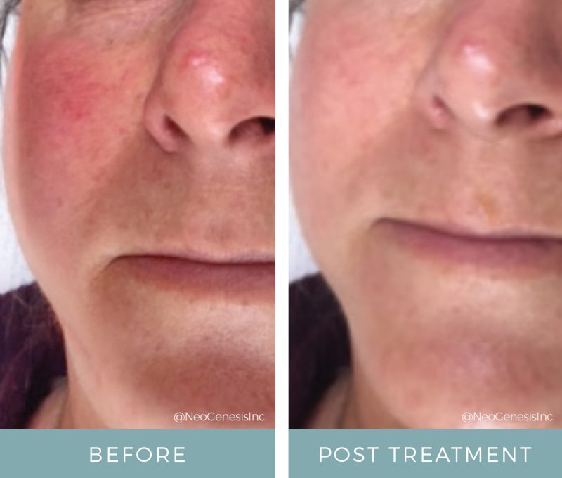 Before + After - Rosacea