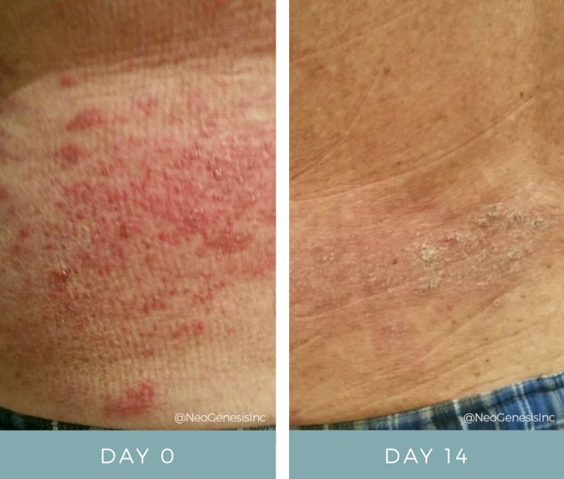Before + After - Shingles