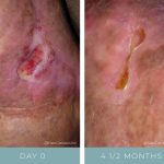 Before + After - Wound Care