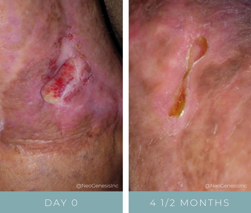 Before + After - Wound Care