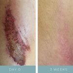 Before + After - Wound Care