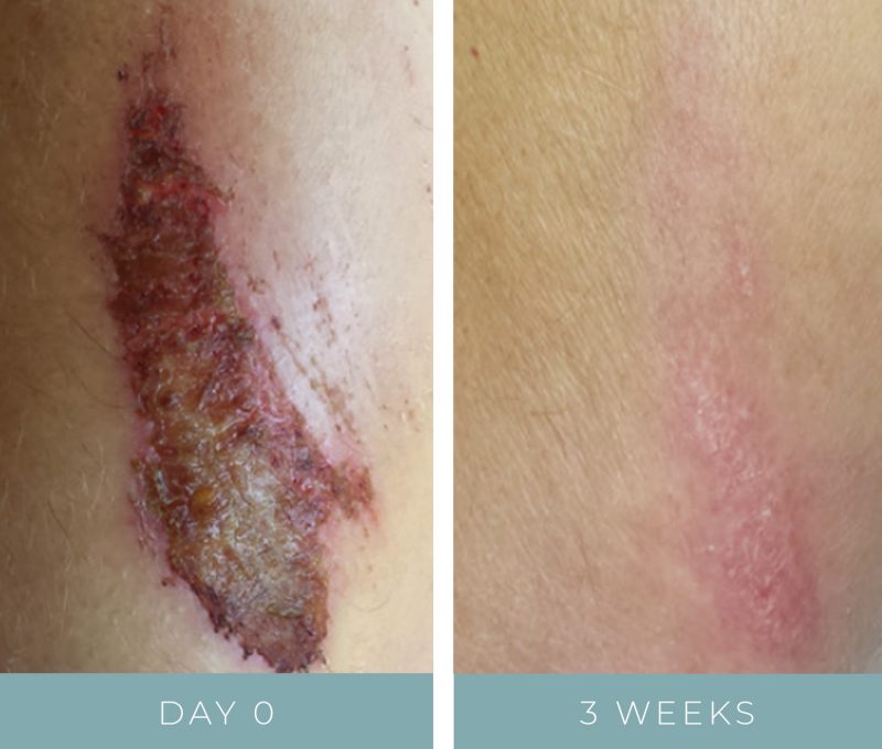 Before + After - Wound Care