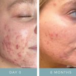 Before + After - Acne