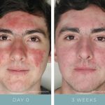 Before + After - Acne