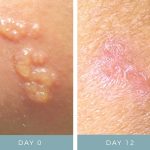 Before + After - Shingles