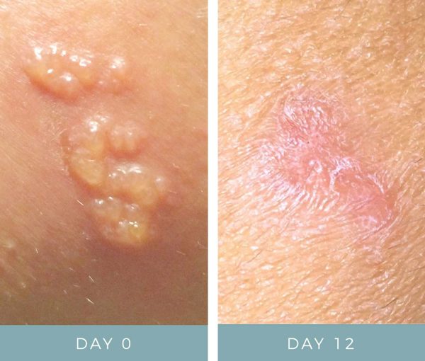 Before + After - Shingles