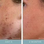 Acne - Before + After