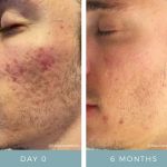 Acne - Before + After