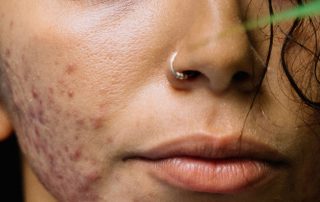 Acne Care Solutions for Your Clinic