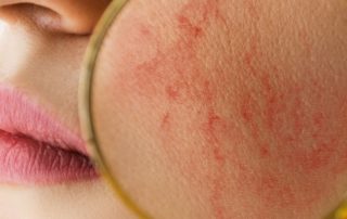 Skincare Protocol for Rosacea-Prone Skin