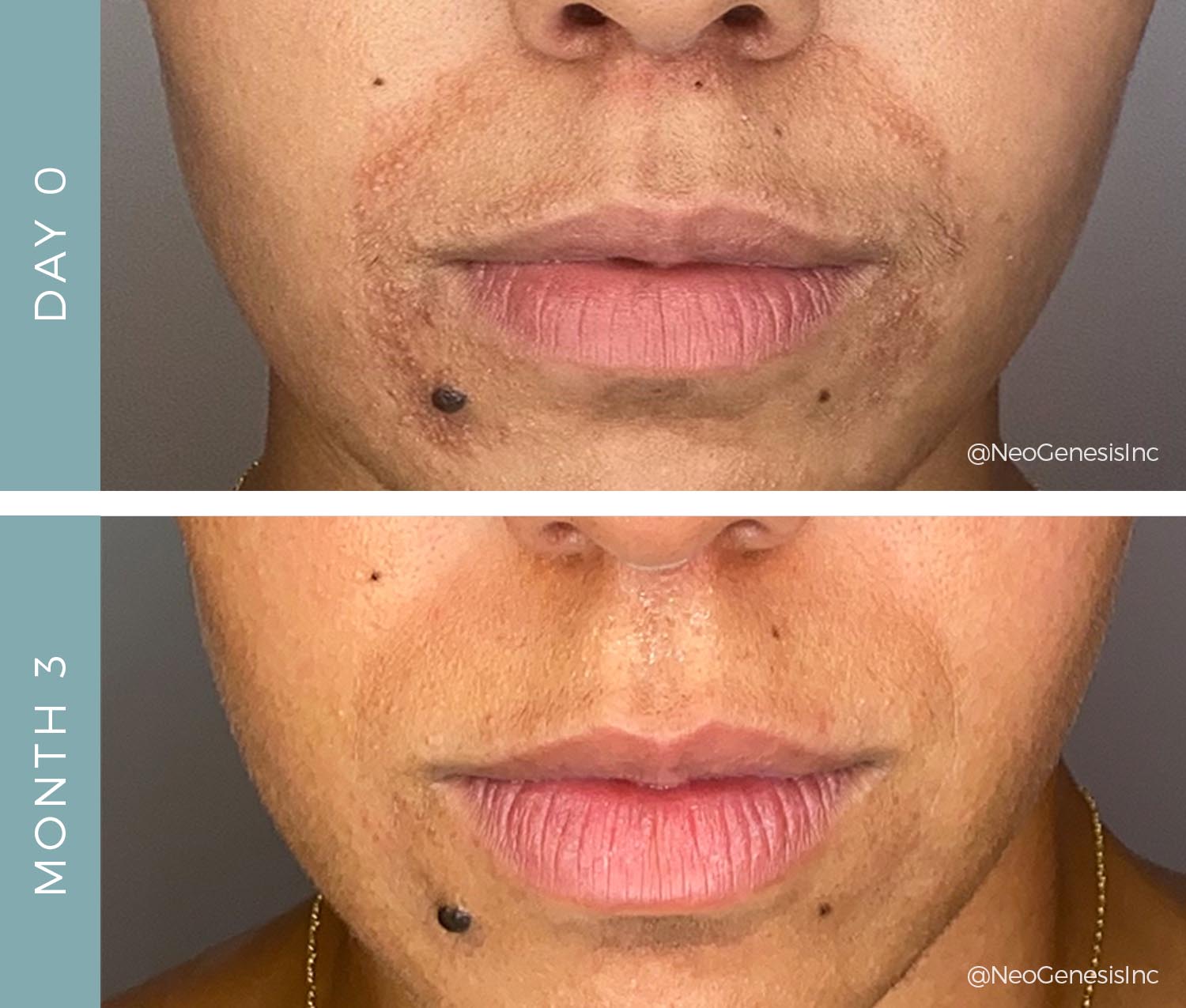 Before + After – Perioral Dermatitis Before + After - Perioral Dermatitis
